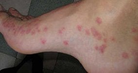 Bed Bugs control in Monmouth County